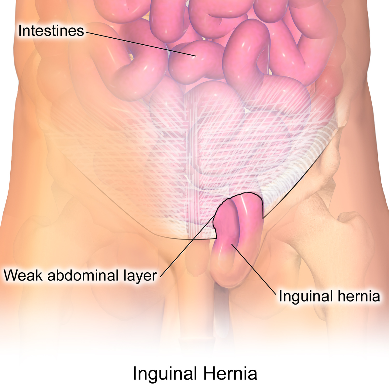 indirect vs direct inguinal hernia